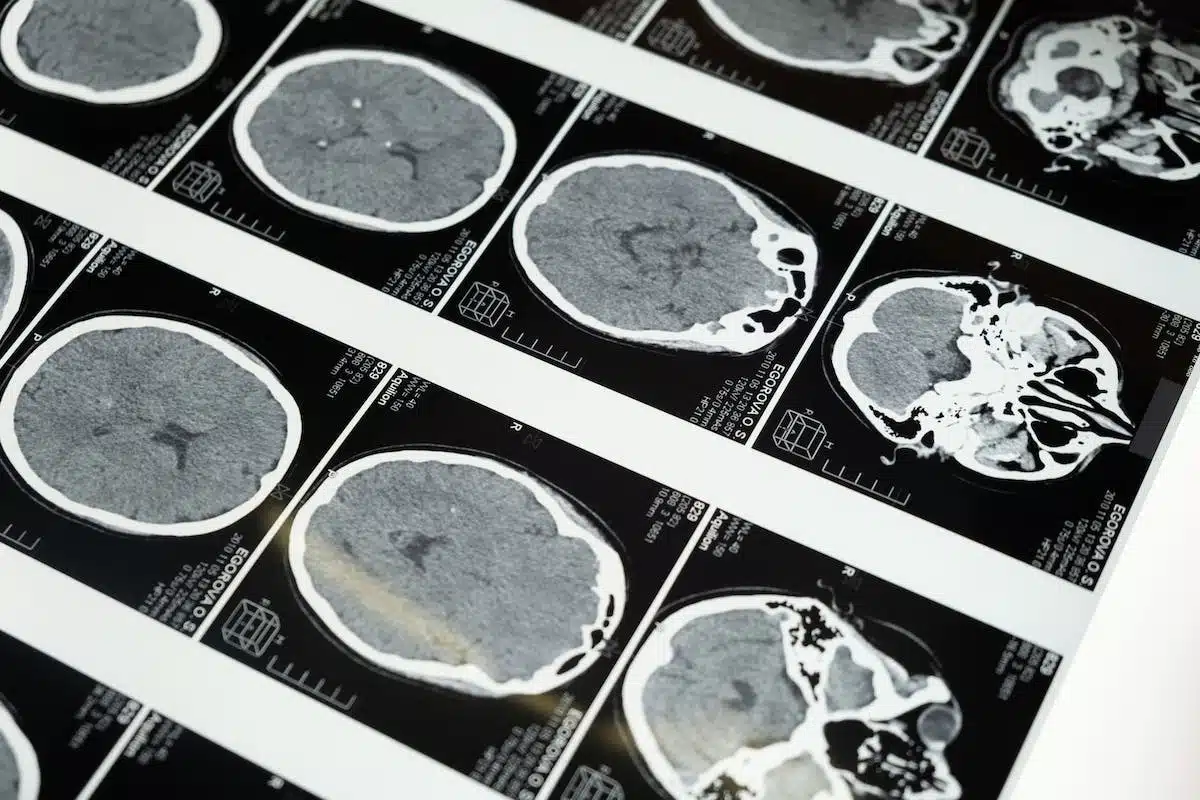 cerveau  alzheimer